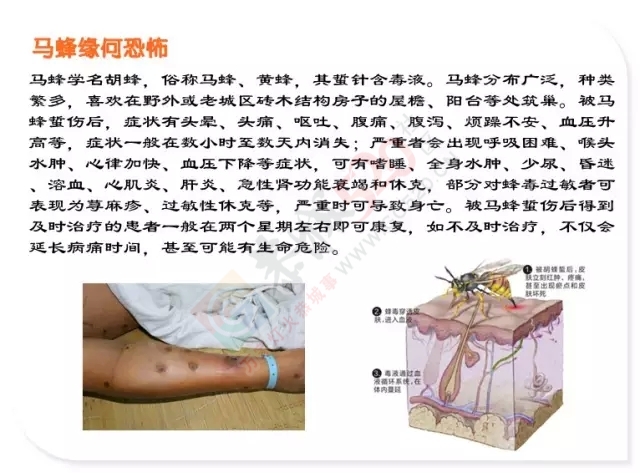 病危！广西4岁女童被马蜂蜇了140处！689 / 作者:太天真 / 帖子ID:128284