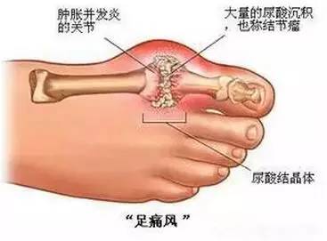 万万没想到痛风可以这样治.812 / 作者:人艰不拆 / 帖子ID:163420