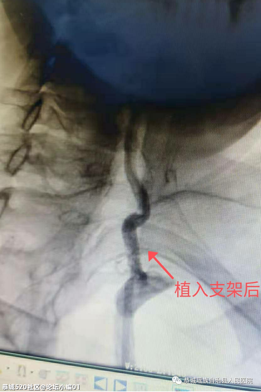 小针口大疗效，必要时可救命〡恭城只有这里能做，别不知道！160 / 作者:论坛小编01 / 帖子ID:286048