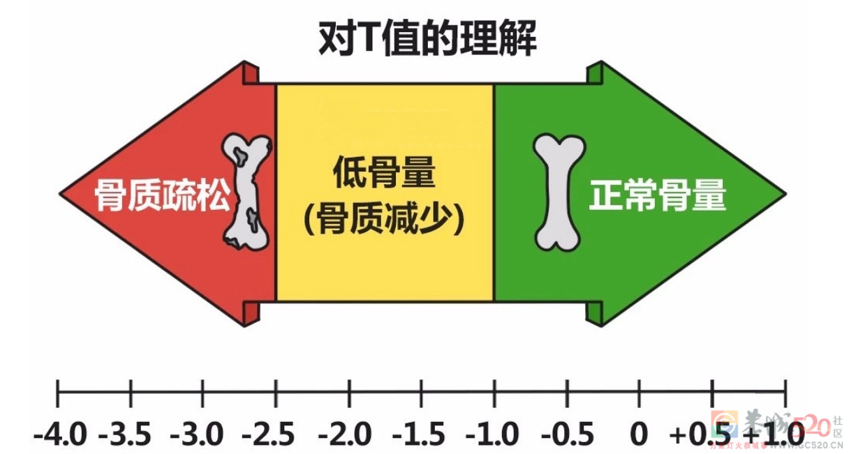 骨质疏松的危害被低估了！骨头脆，易诱发全身感染938 / 作者:健康小天使 / 帖子ID:305883