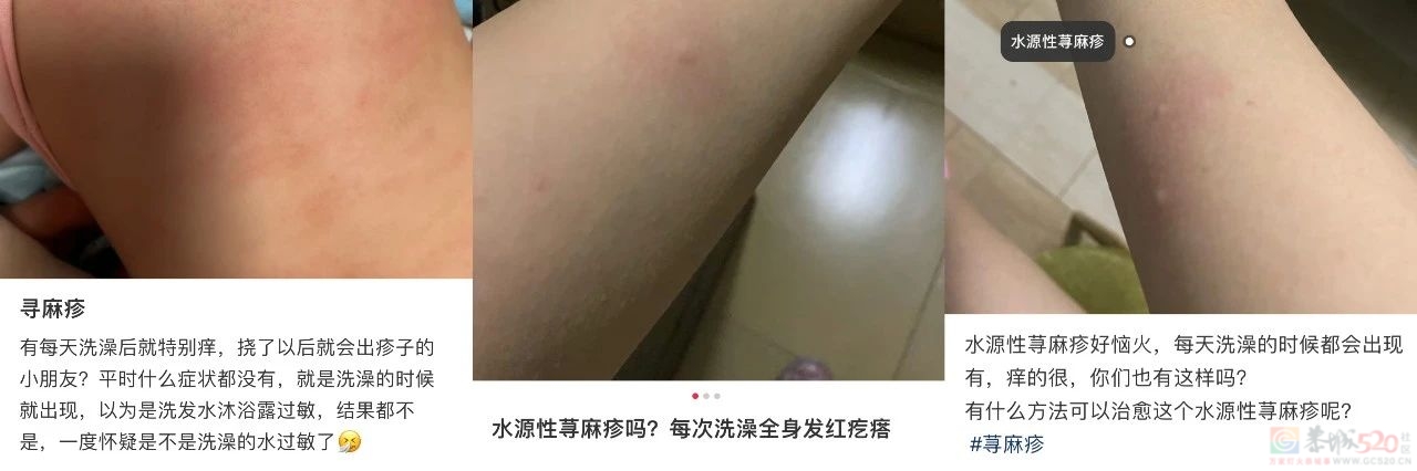 真的有人对“洗澡”过敏？盘点意想不到的荨麻疹诱因548 / 作者:健康小天使 / 帖子ID:310046