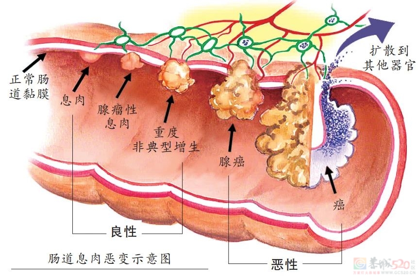 为什么一发现肠息肉就要切除？这3种息肉易癌变28 / 作者:健康小天使 / 帖子ID:313310