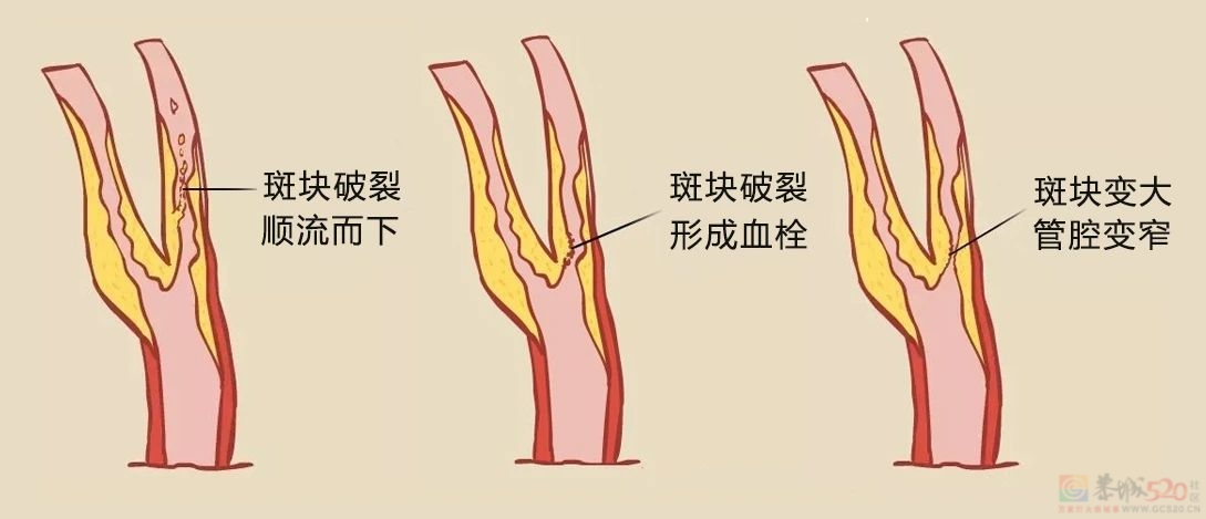 身体有3种不适，提示「斑块」随时会脱落60 / 作者:健康小天使 / 帖子ID:317739